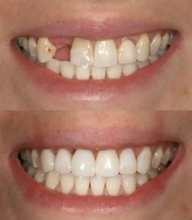 Before and after photos of a dental implant smile transformation at The Dental Implant Institute